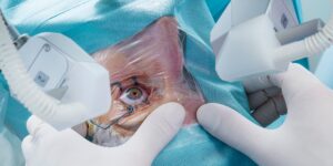 Exploring the Benefits of Advanced Technology Cataract Surgery